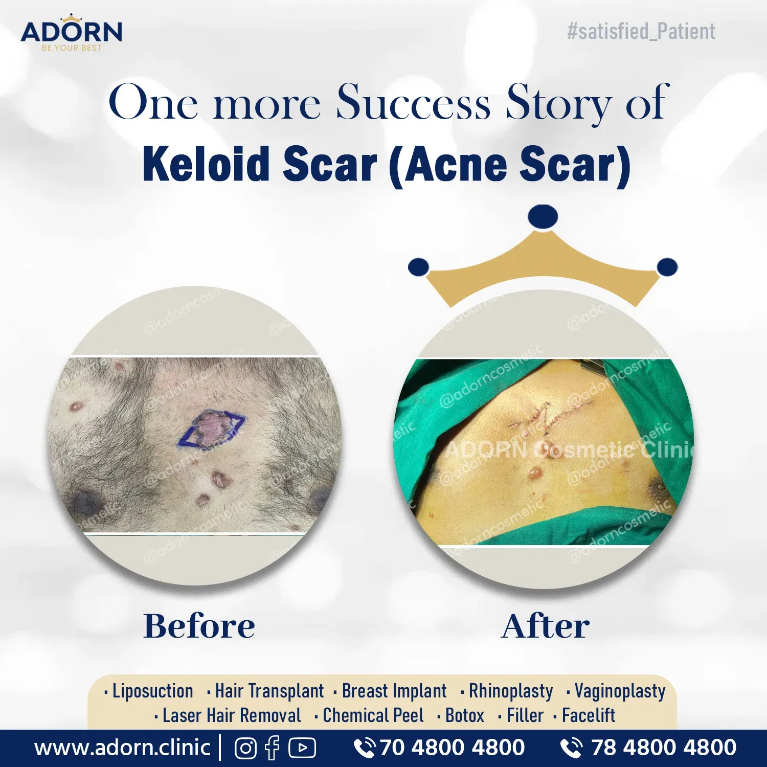 Keloid | Before and After Plastic Surgery Results | Adorn Clinic