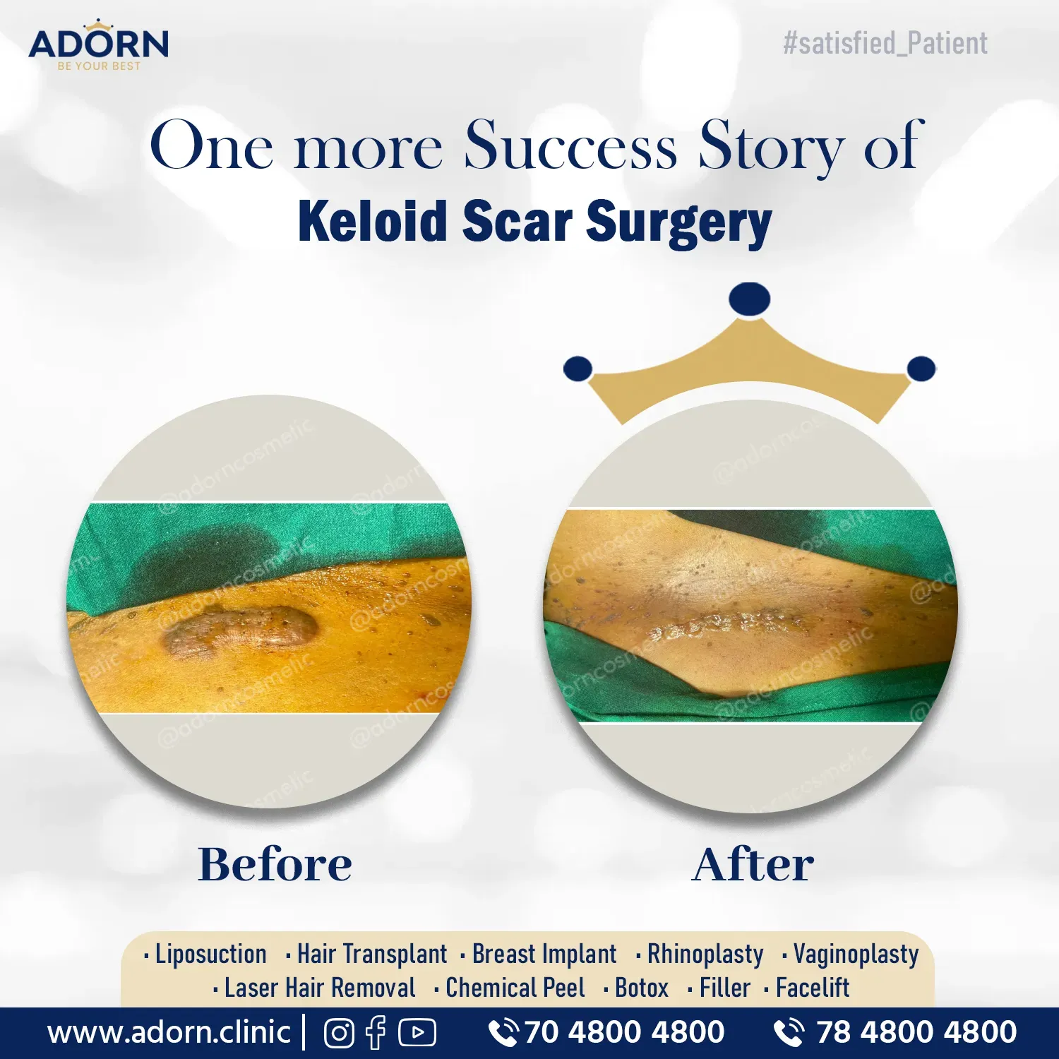 Keloid | Before and After Plastic Surgery Results | Adorn Clinic