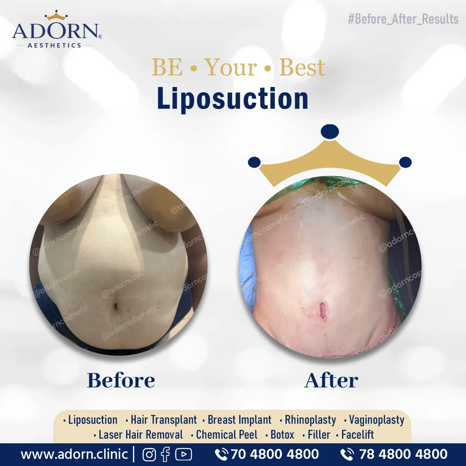 Abdominoplasty | Before and After Plastic Surgery Results | Adorn Clinic