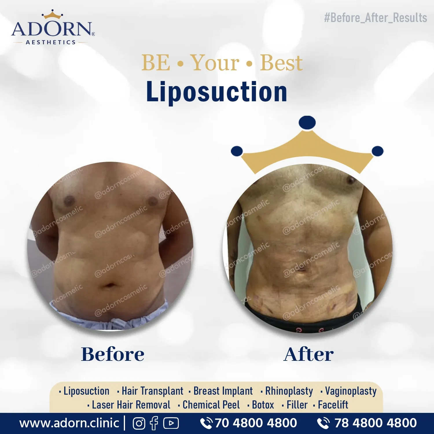 Quantum RF with Lipo | Before and After Plastic Surgery Results | Adorn Clinic