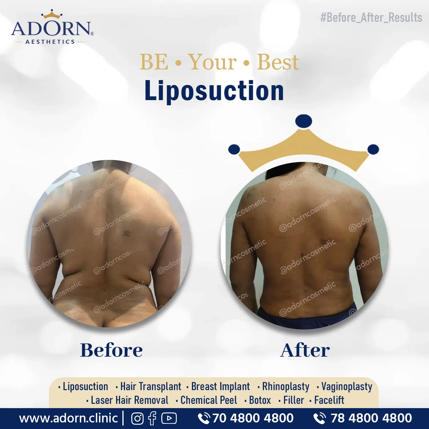 Back Liposuction | Before and After Plastic Surgery Results | Adorn Clinic