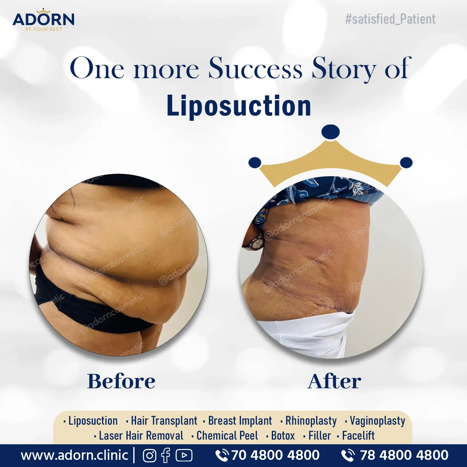 Tummy Tuck | Before and After Plastic Surgery Results | Adorn Clinic