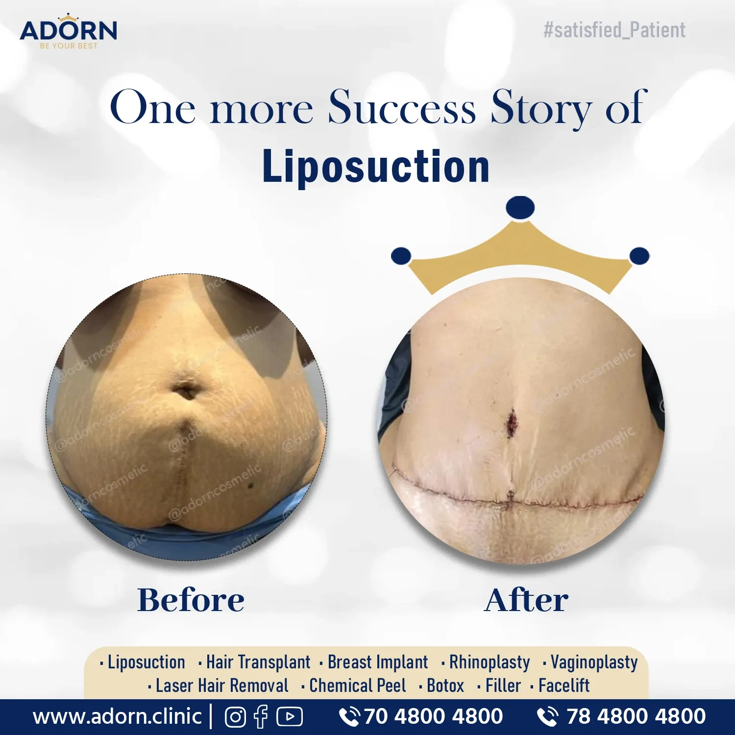 Abdominoplasty | Before and After Plastic Surgery Results | Adorn Clinic