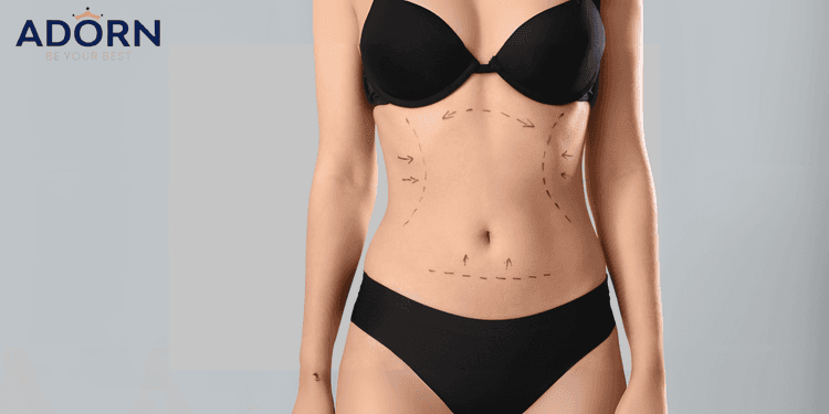 Liposuction in Ahmedabad: Cost, Procedure, & Recovery Liposuction in Ahmedabad Cost