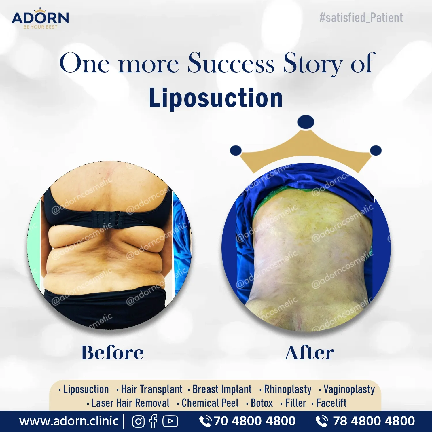 Bra Bulge Lower Back Liposuction | Before and After Plastic Surgery Results | Adorn Clinic