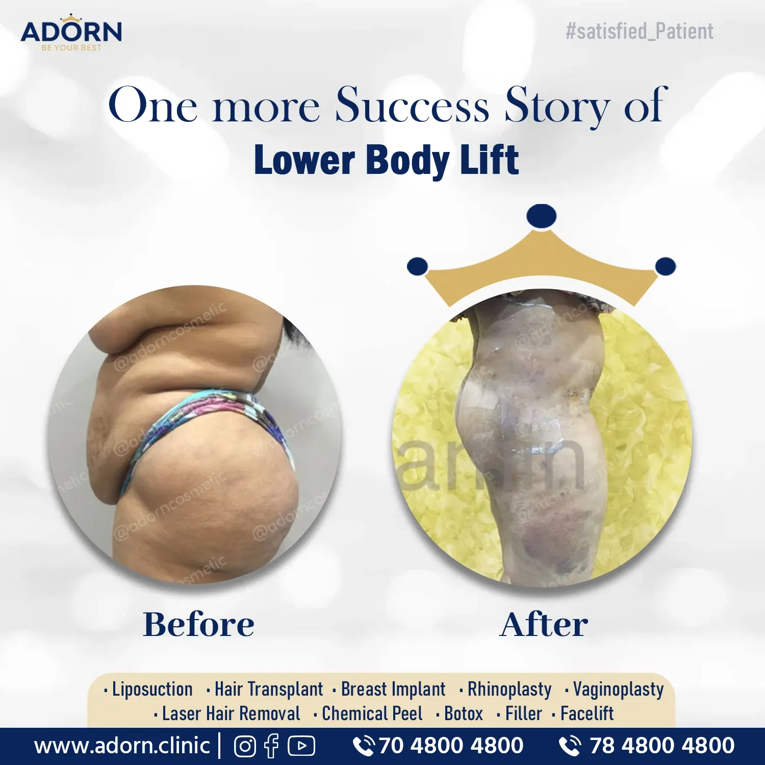 Lower Body Lift tummy butt thigh | Before and After Plastic Surgery Results | Adorn Clinic