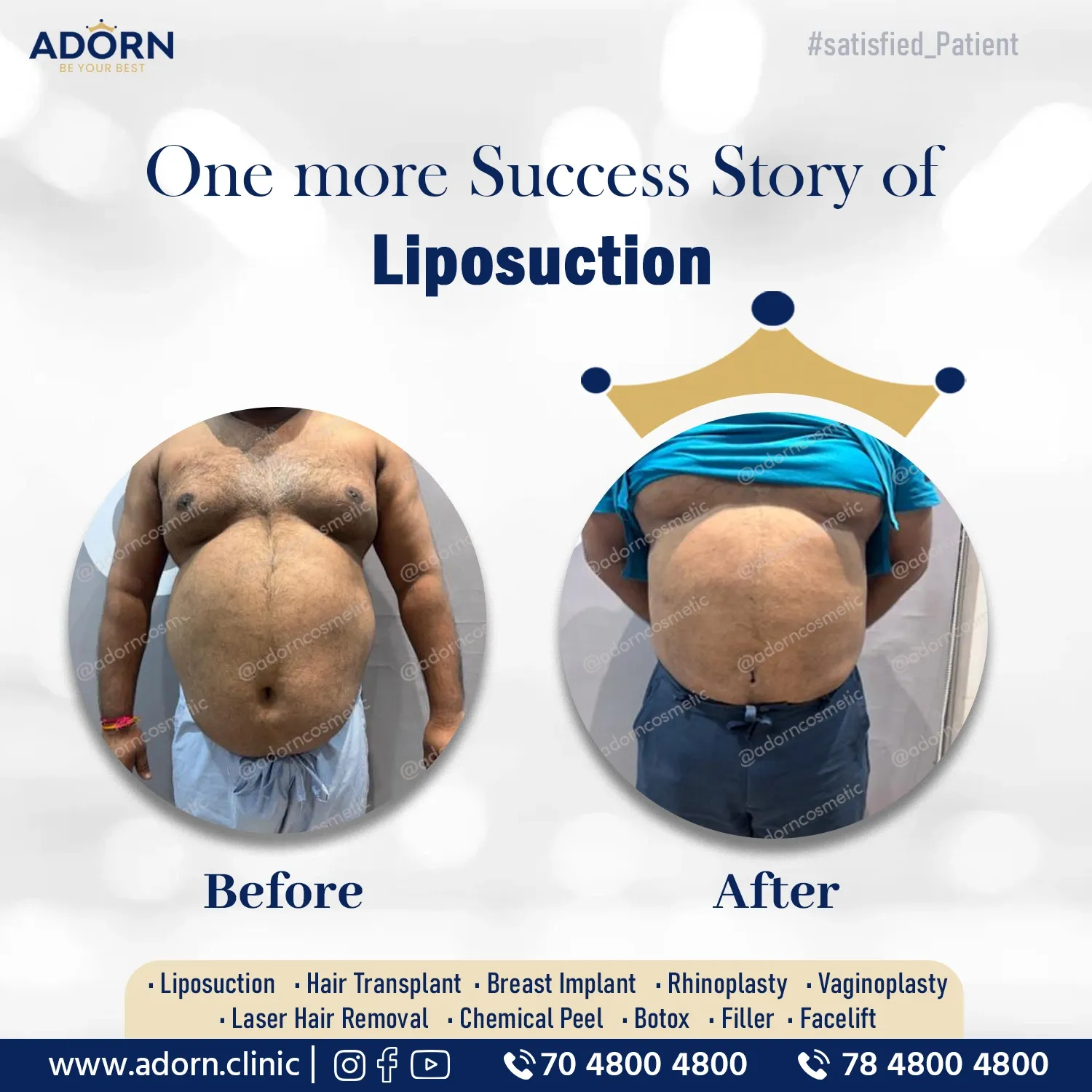 Male Tummy Liposuction | Before and After Plastic Surgery Results | Adorn Clinic