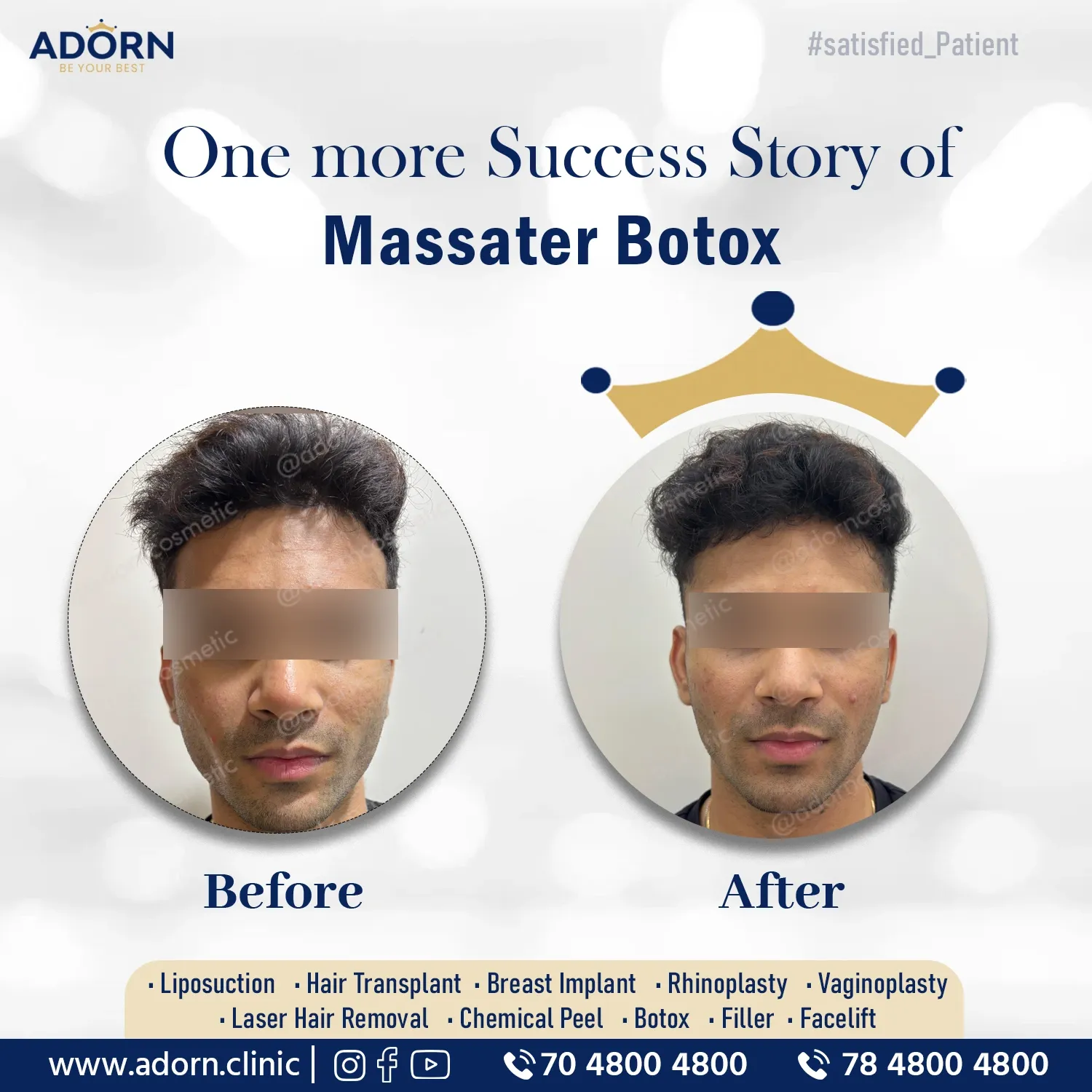 Jawline botox | Before and After Plastic Surgery Results | Adorn Clinic
