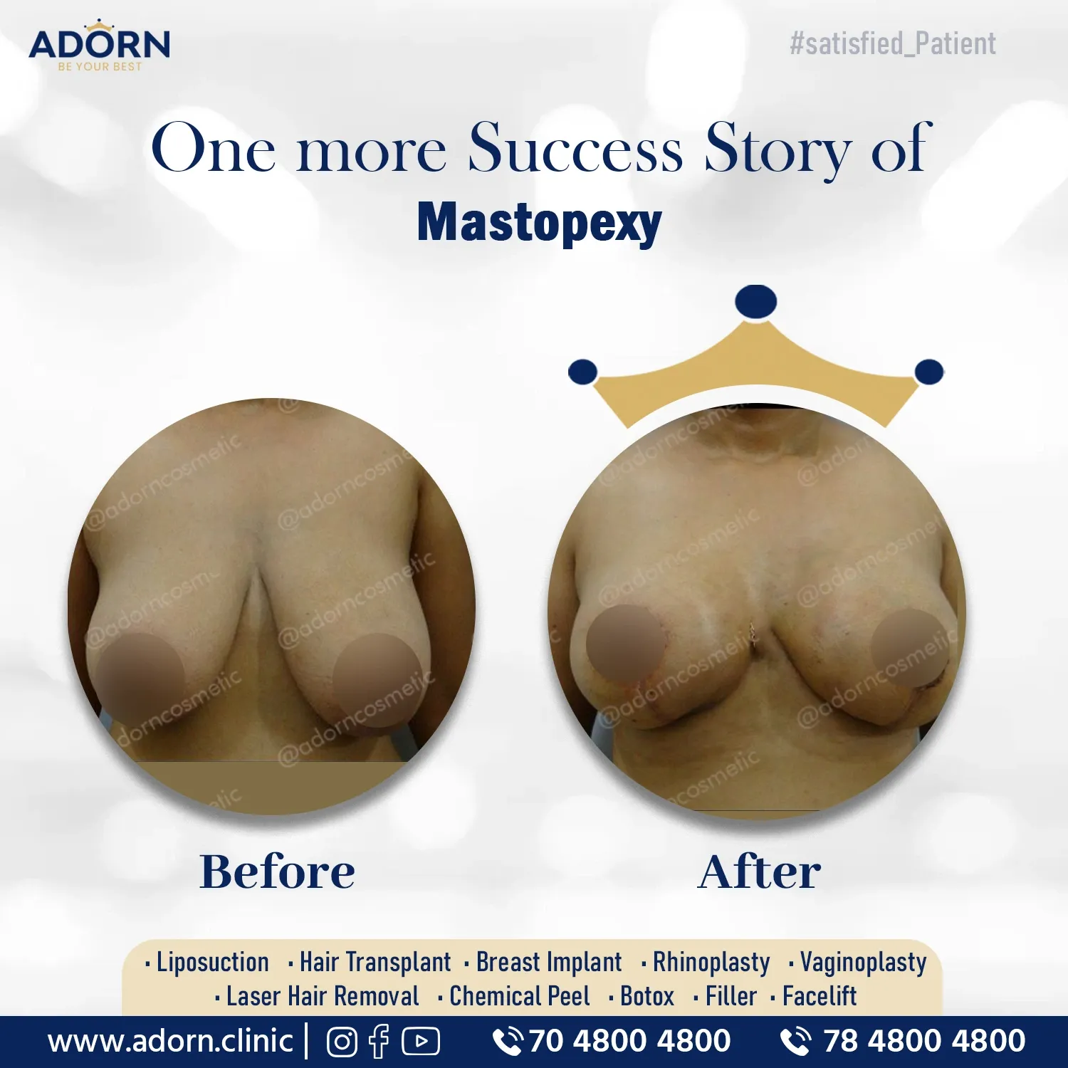 Breast Lift | Before and After Plastic Surgery Results | Adorn Clinic