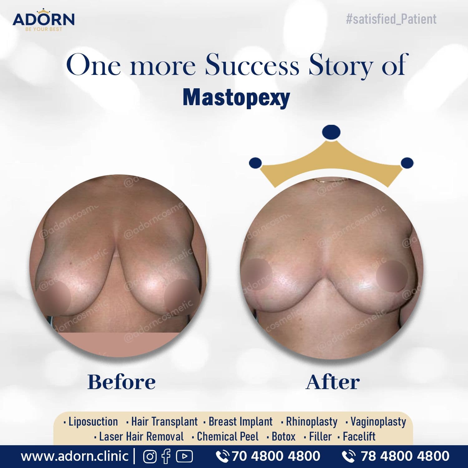 Breast Reduction Lift