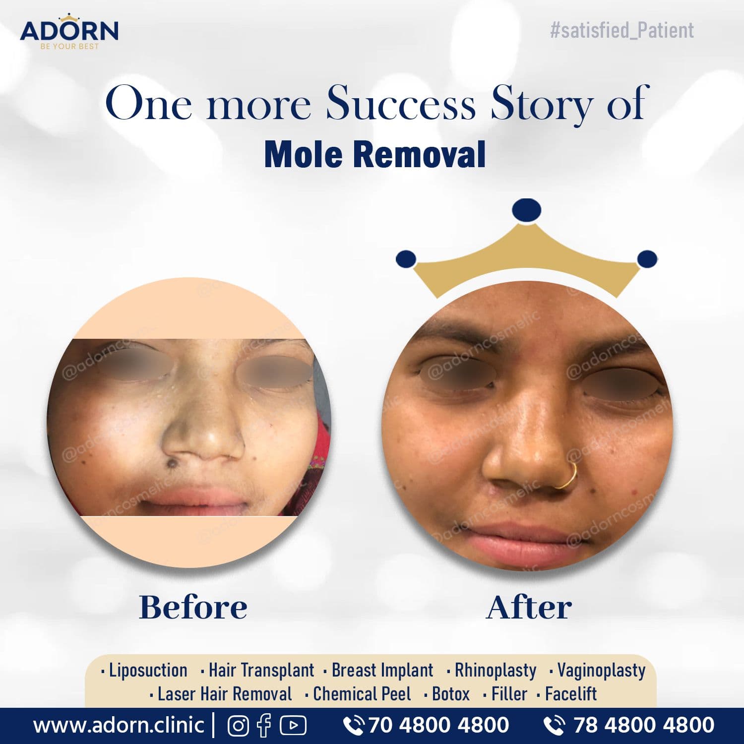 Mole on lips | Before and After Plastic Surgery Results | Adorn Clinic