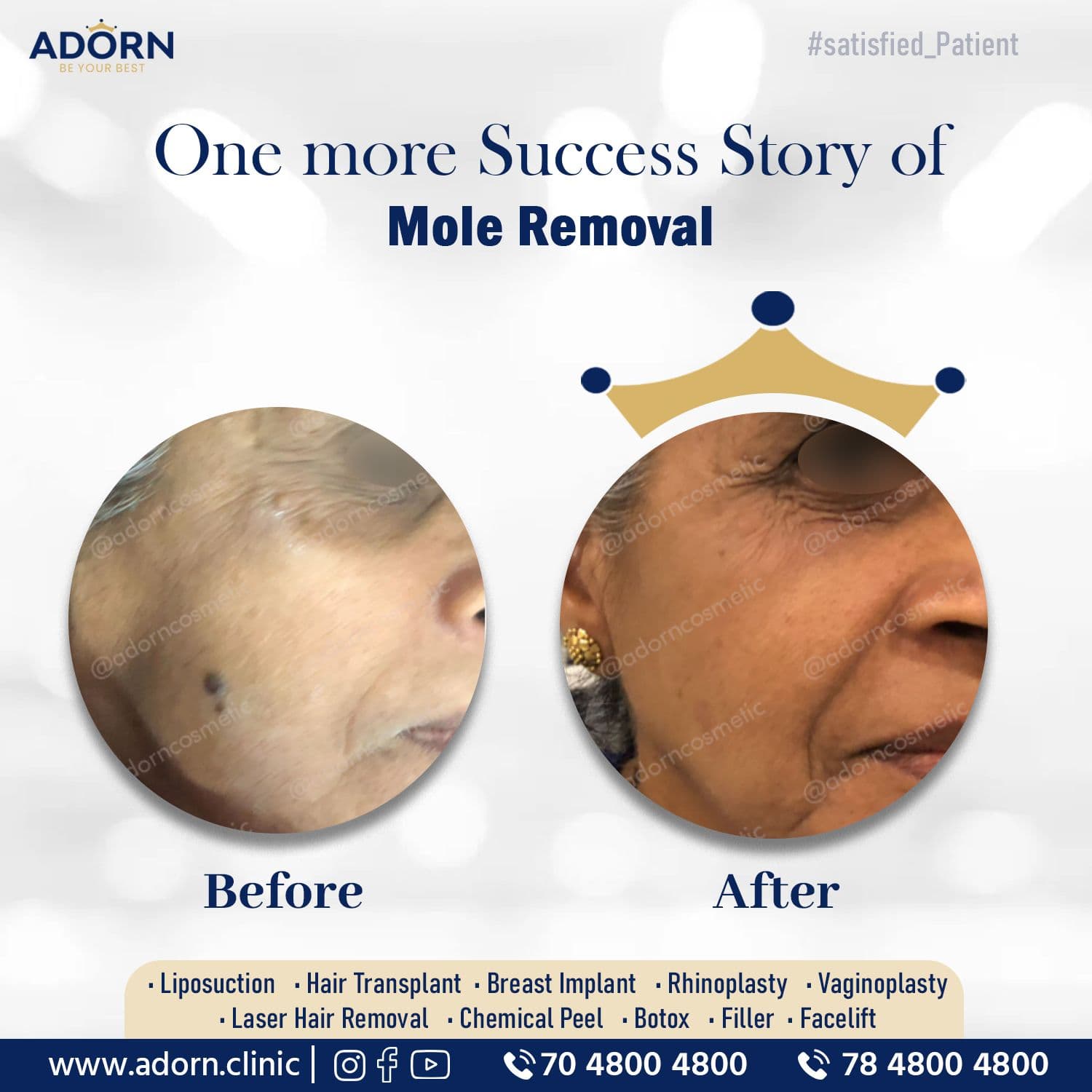 Mole | Before and After Plastic Surgery Results | Adorn Clinic