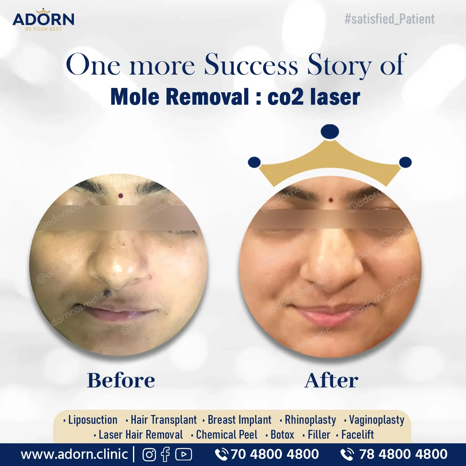 Mole Removals | Before and After Plastic Surgery Results | Adorn Clinic