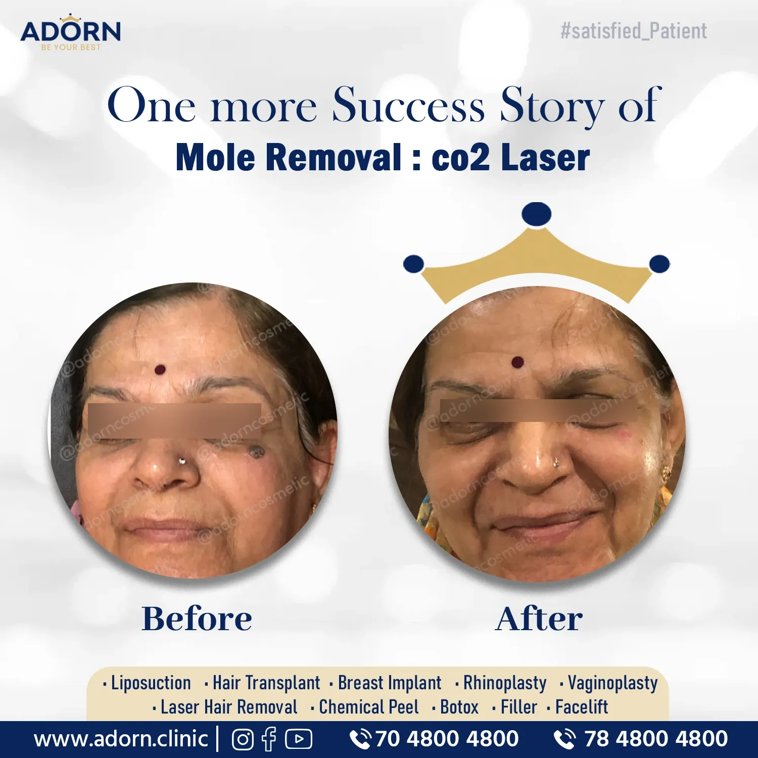 Mole Removal | Before and After Plastic Surgery Results | Adorn Clinic