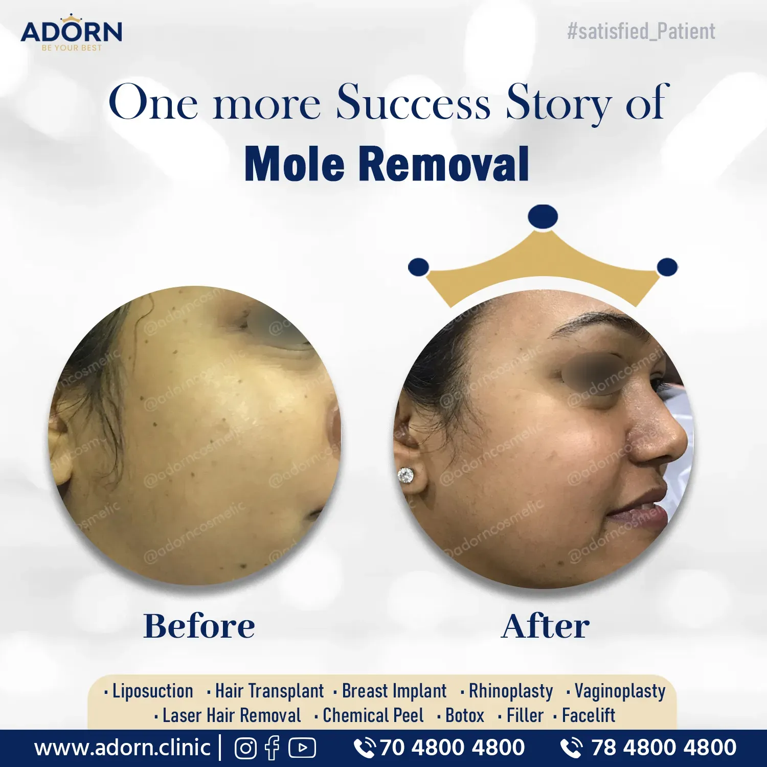Mole removal | Before and After Plastic Surgery Results | Adorn Clinic