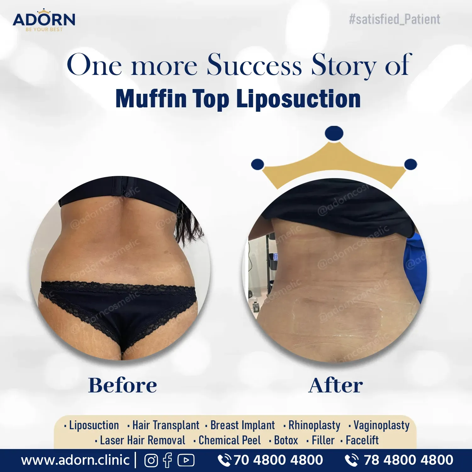 Back Liposuction | Before and After Plastic Surgery Results | Adorn Clinic