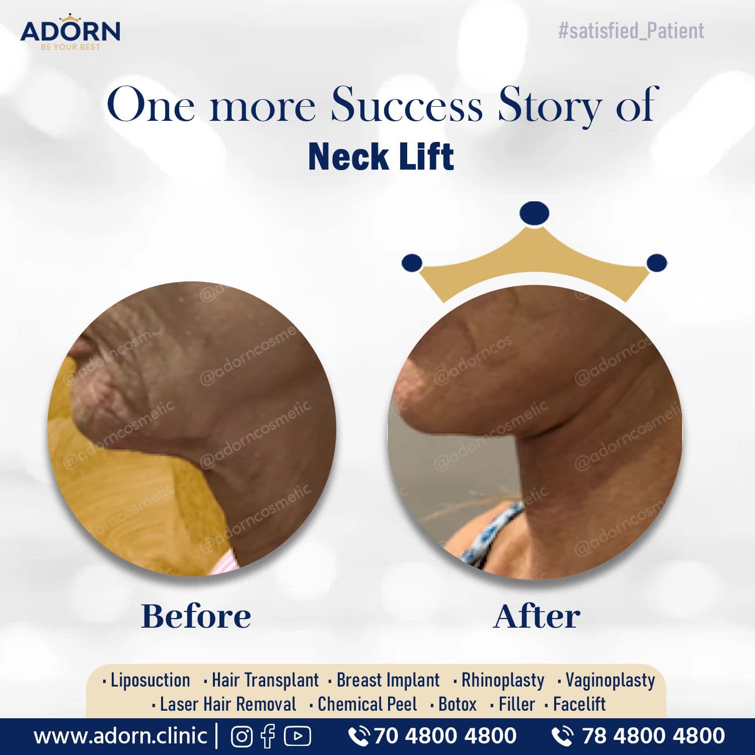 Face Lift + Neck lift | Before and After Plastic Surgery Results | Adorn Clinic