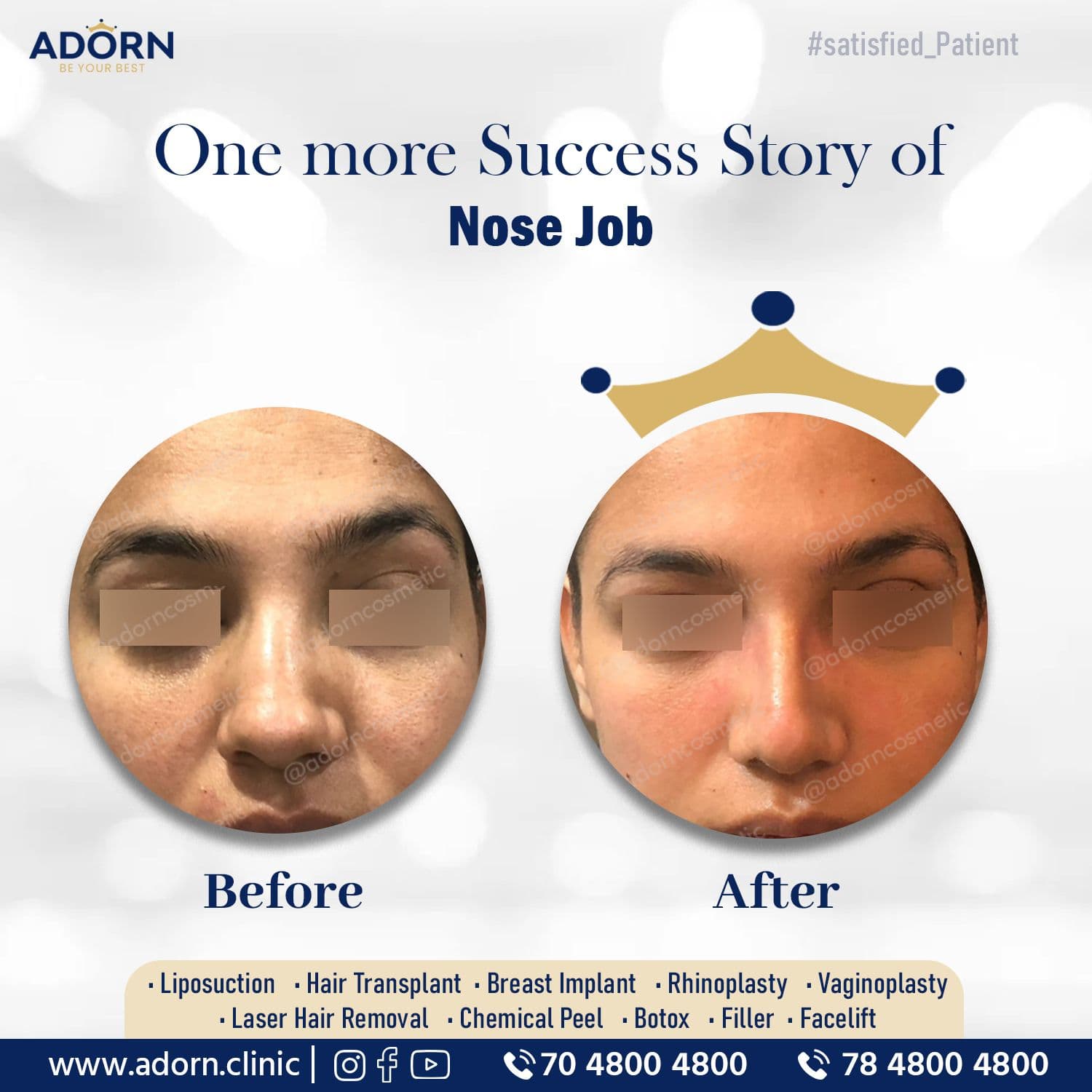 Wide Nose / Bulbous Tip / Septoplasty | Before and After Plastic Surgery Results | Adorn Clinic