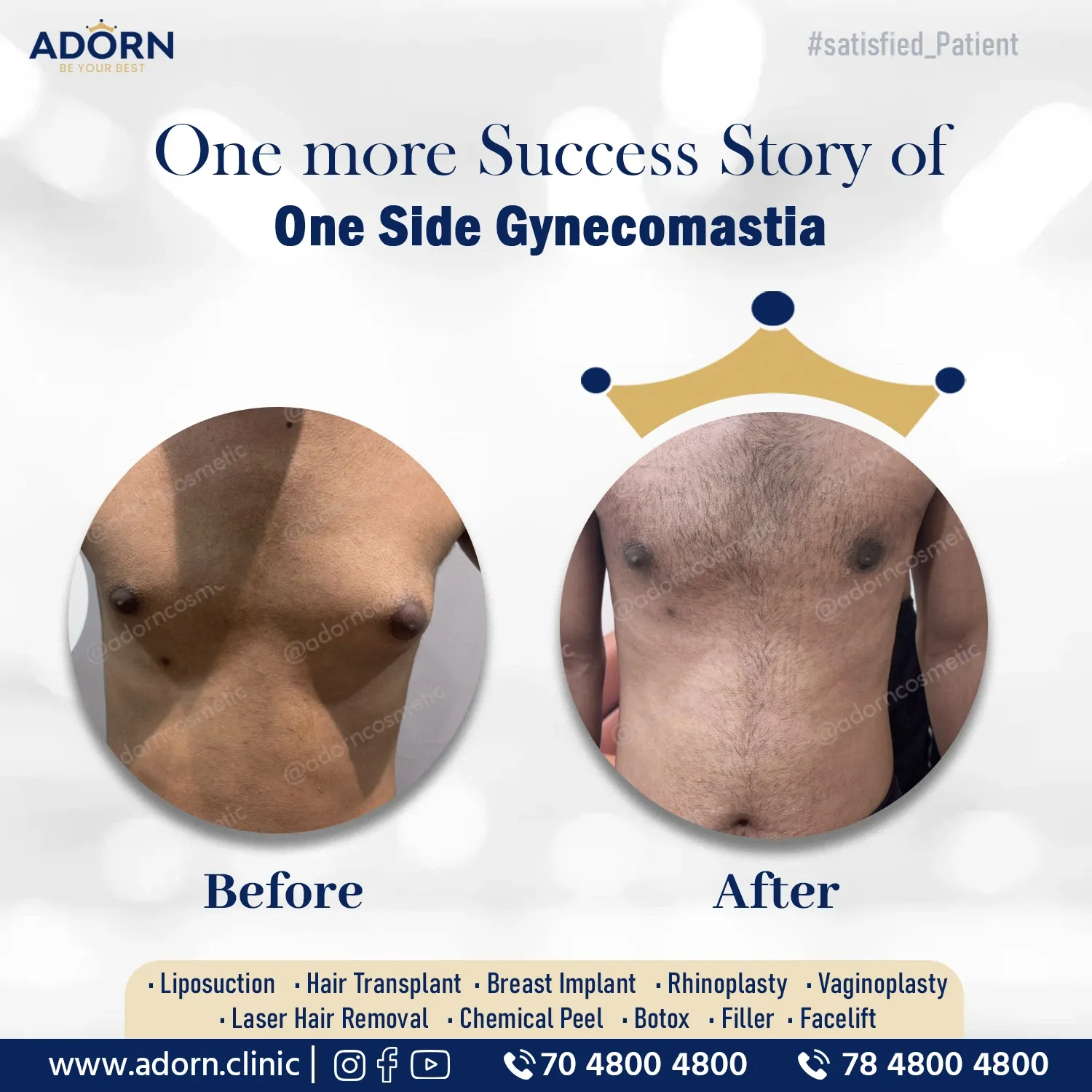 Unilateral Gynecomastia | Before and After Plastic Surgery Results | Adorn Clinic