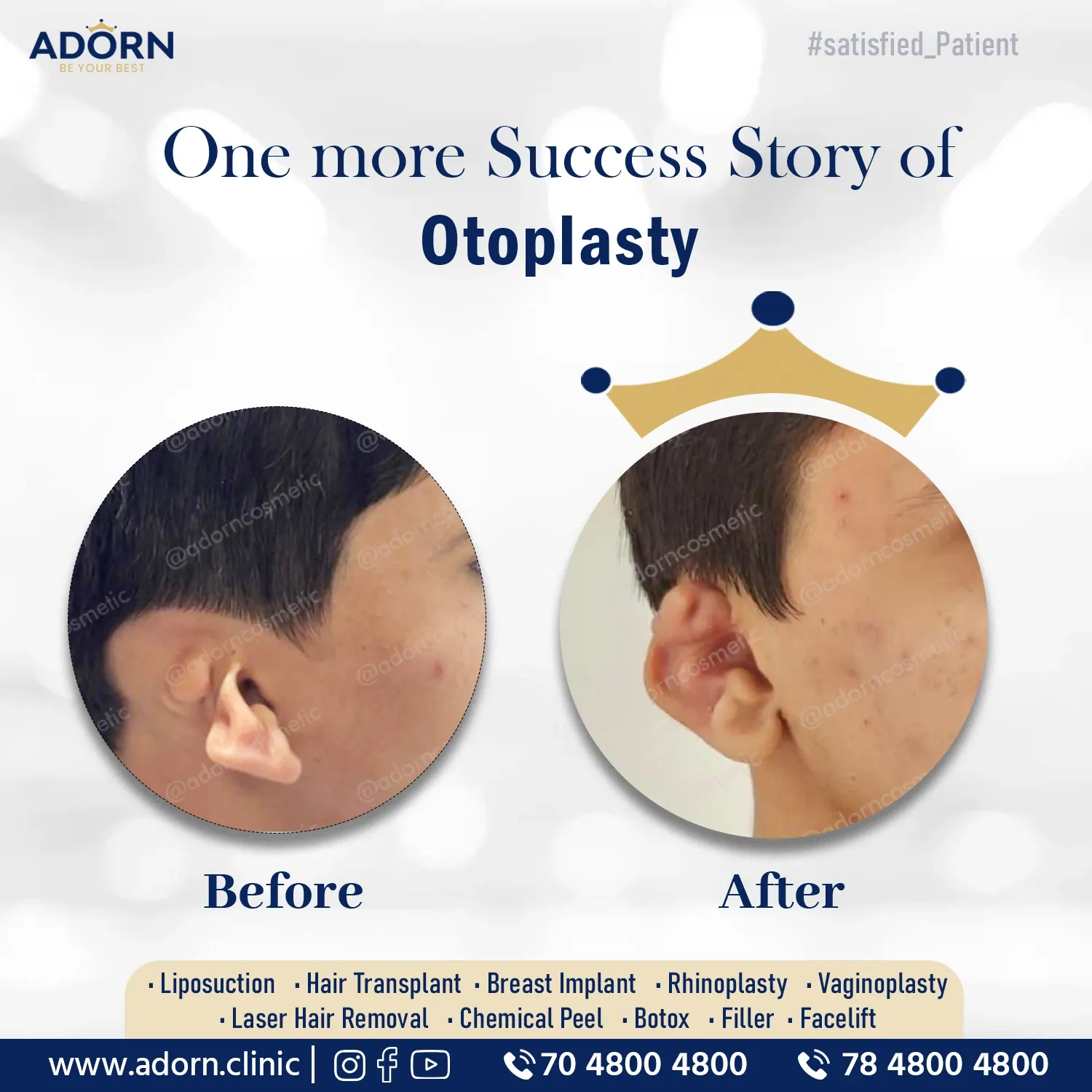 Ear Reconstruction | Before and After Plastic Surgery Results | Adorn Clinic