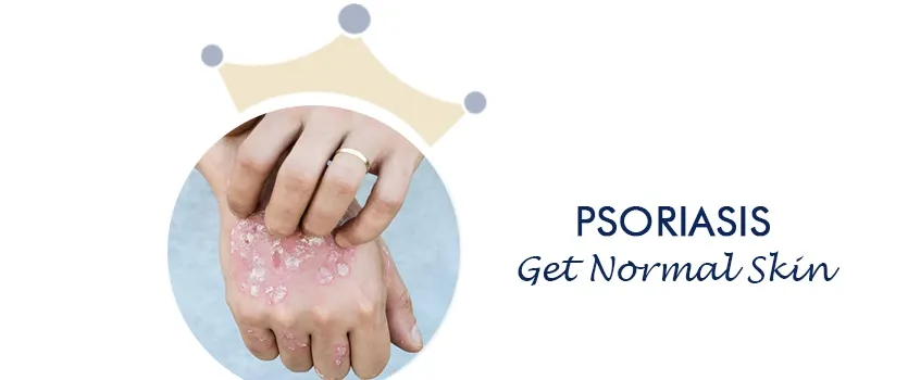 Psoriasis permanent cure in Ahmedabad