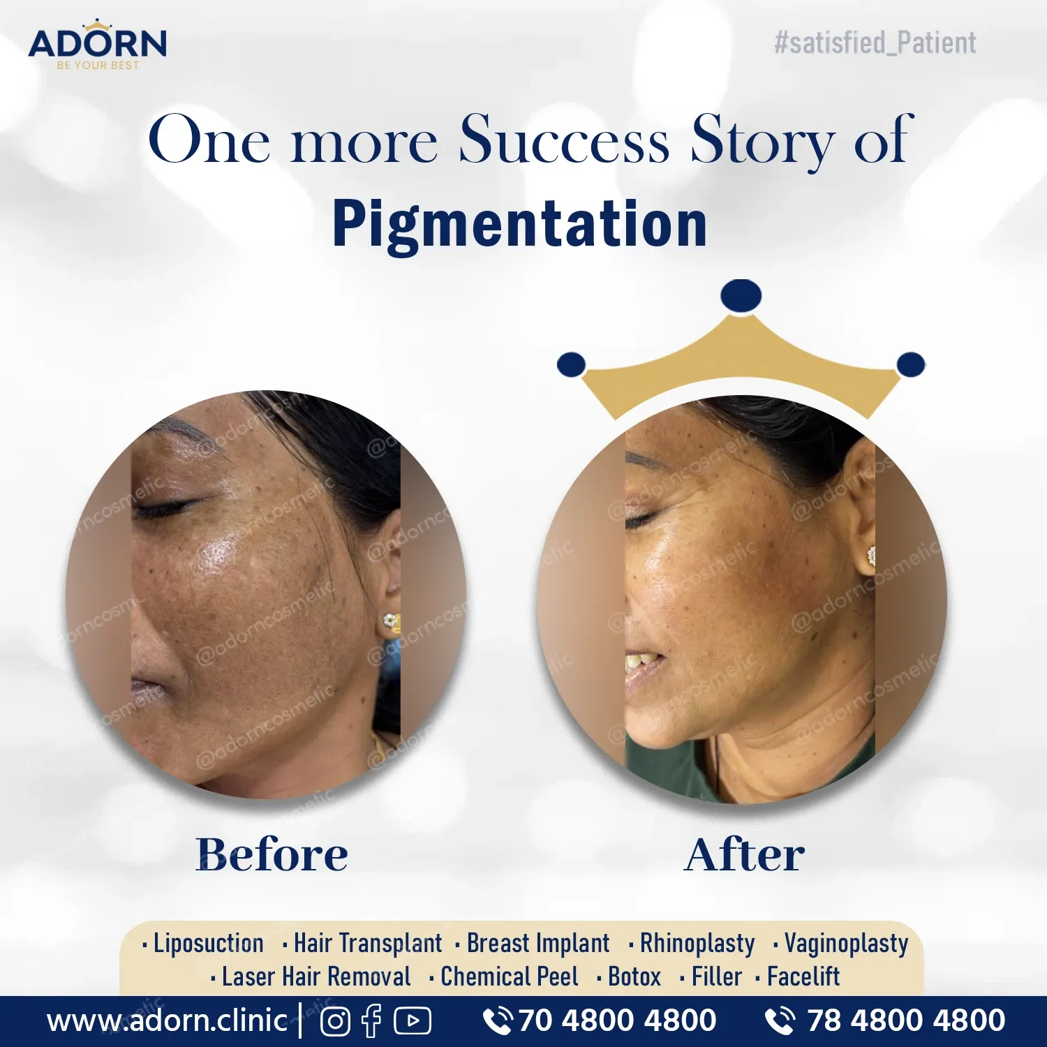Skin Pigmentation and Repair | Before and After Plastic Surgery Results | Adorn Clinic