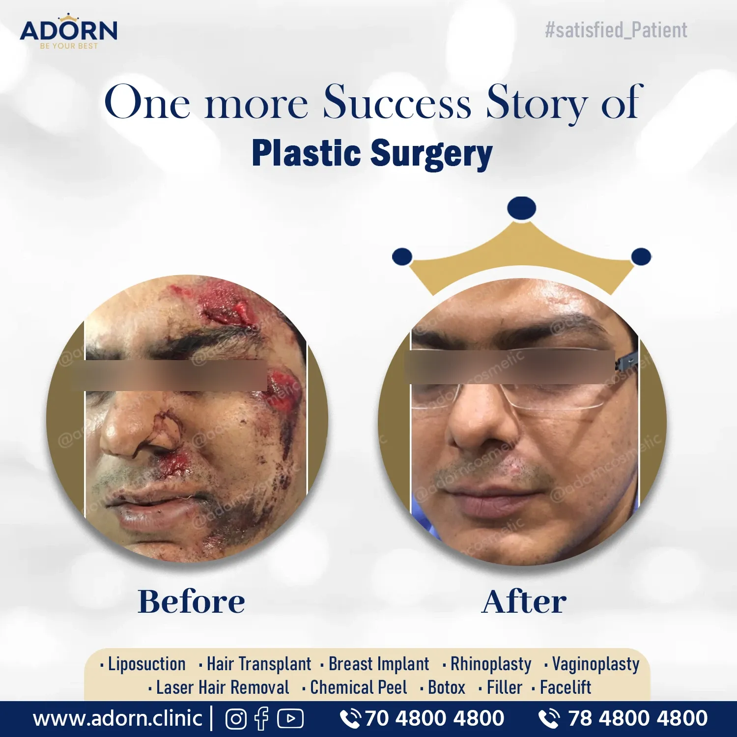 Road Accident | Before and After Plastic Surgery Results | Adorn Clinic