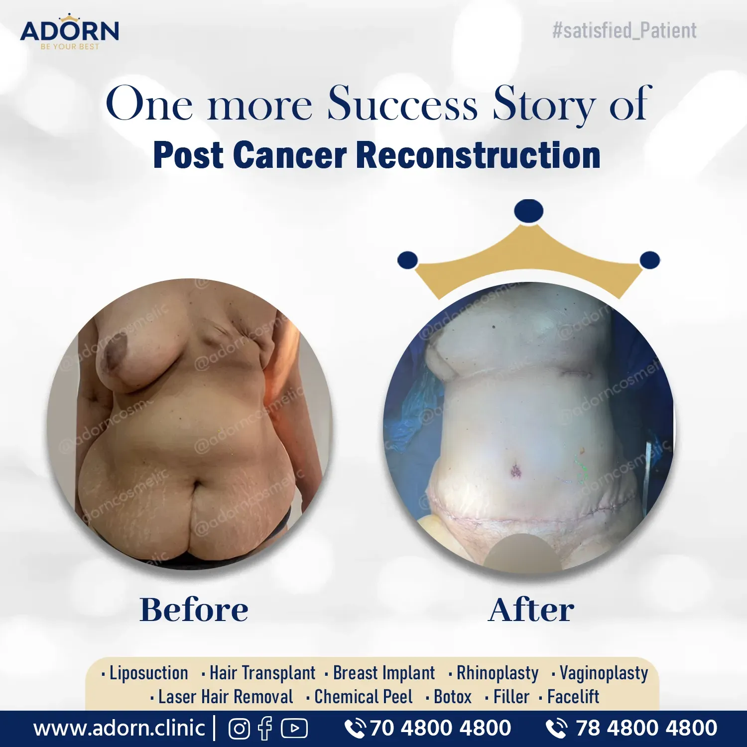 Post Cancer Breast Implant | Before and After Plastic Surgery Results | Adorn Clinic