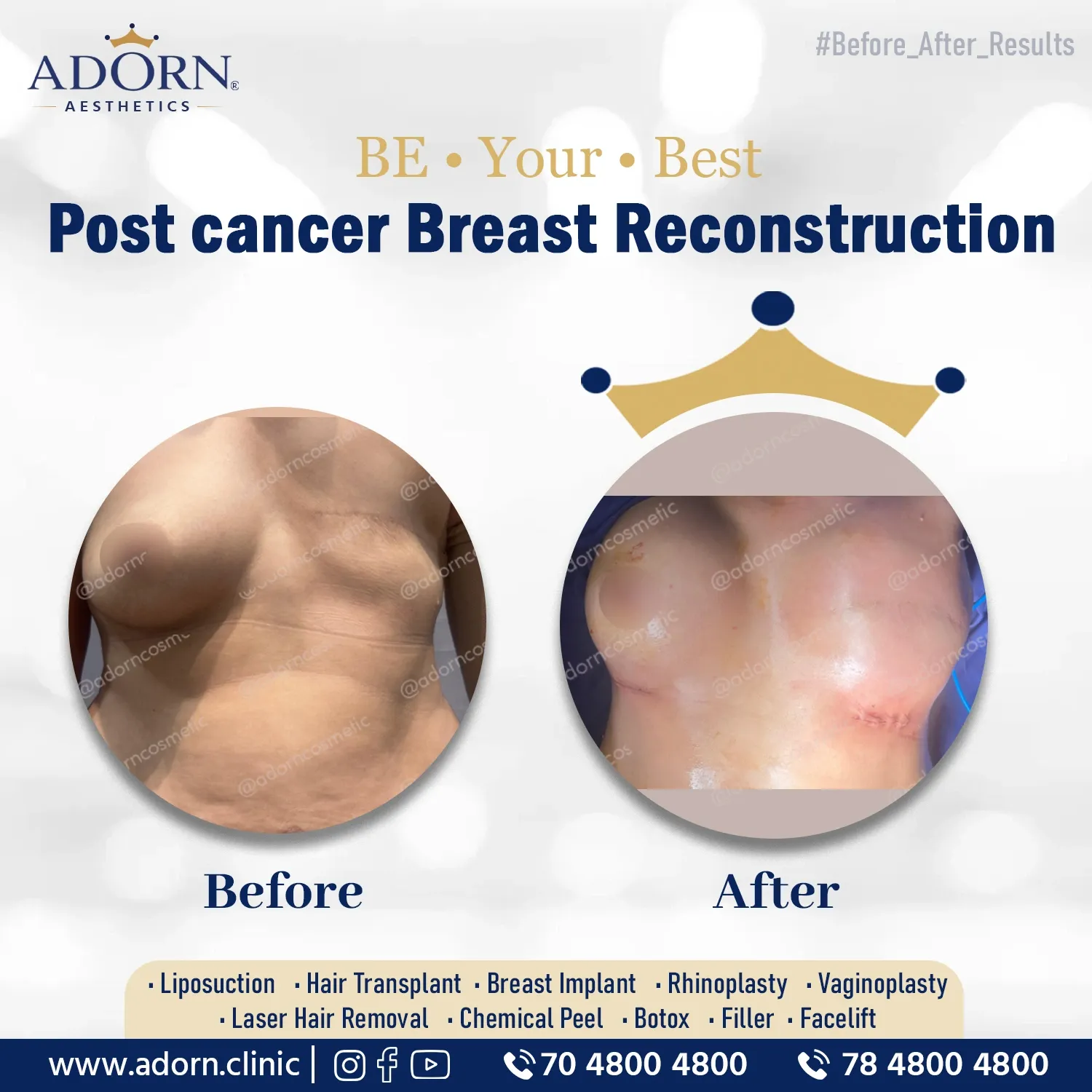 Post Cancer Breast Reconstruction | Before and After Plastic Surgery Results | Adorn Clinic