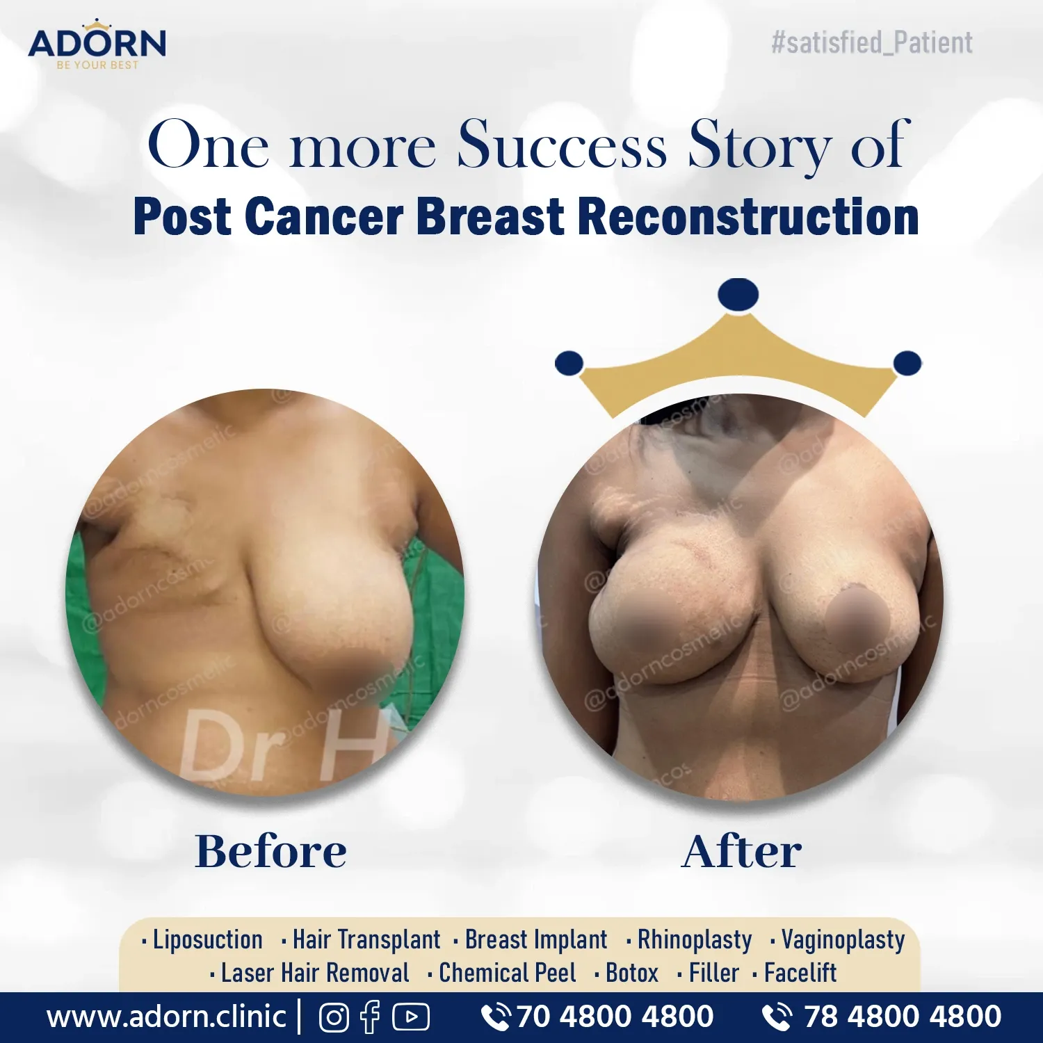 Breast Lift with post cancer reconstruction | Before and After Plastic Surgery Results | Adorn Clinic