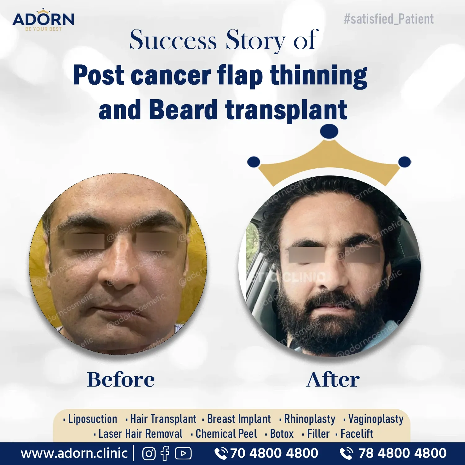 Post Cancer Radiation Beard Loss | Before and After Plastic Surgery Results | Adorn Clinic