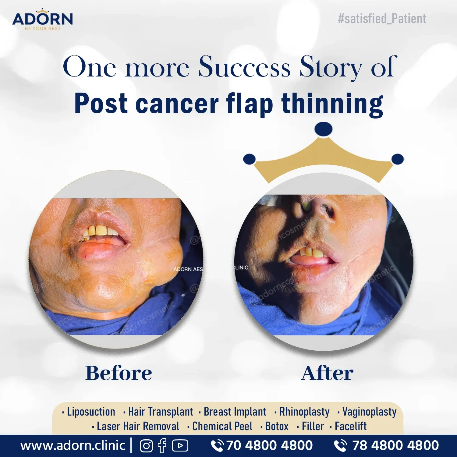 Post Cancer Flap Liposuction | Before and After Plastic Surgery Results | Adorn Clinic