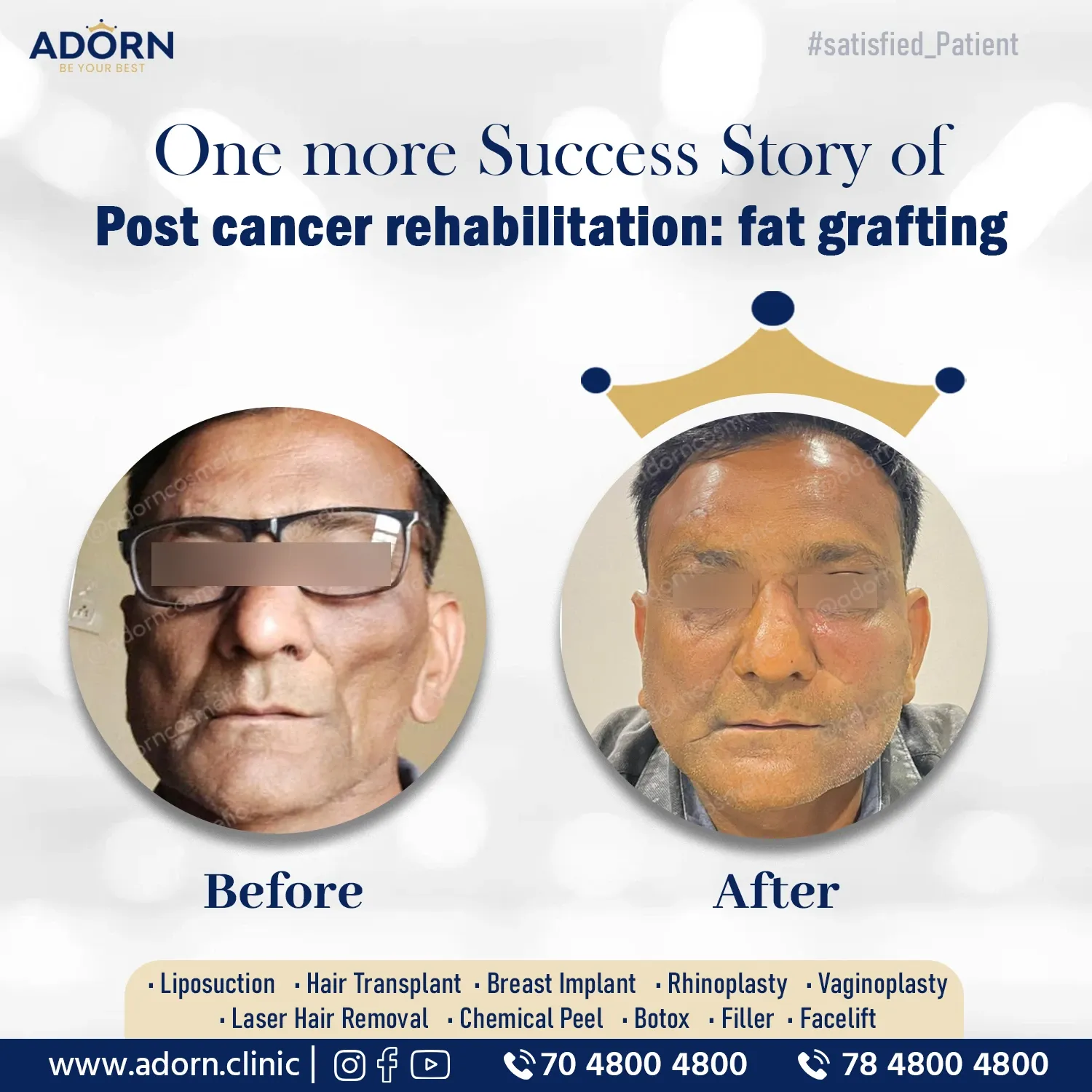 Post cancer Face Deformity | Before and After Plastic Surgery Results | Adorn Clinic