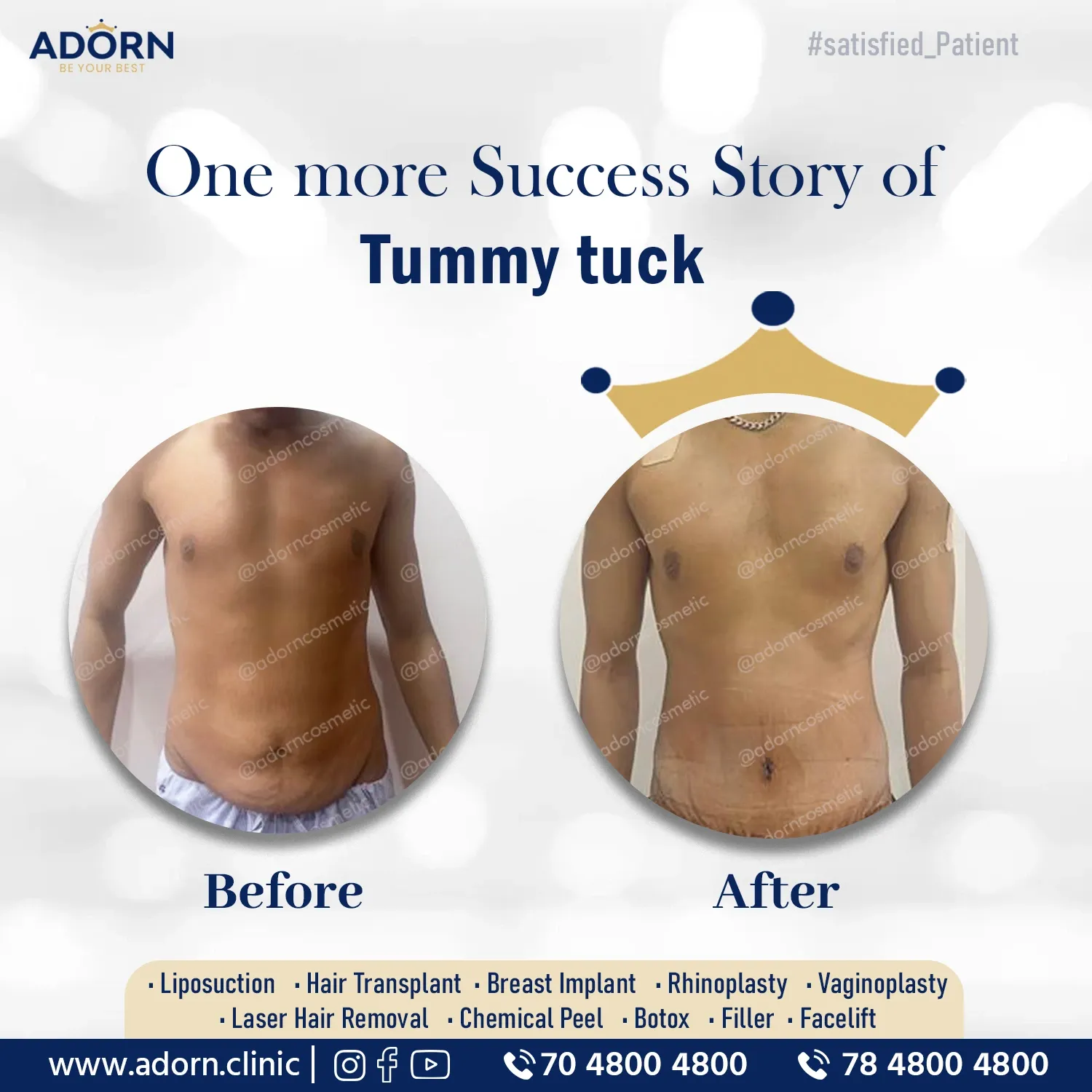 Post Weight loss lose skin | Before and After Plastic Surgery Results | Adorn Clinic