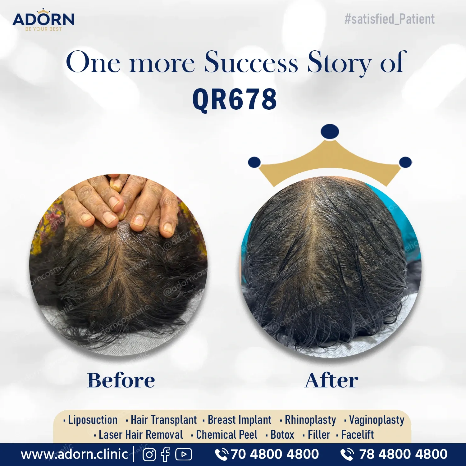 Hair Treatment | Before and After Plastic Surgery Results | Adorn Clinic