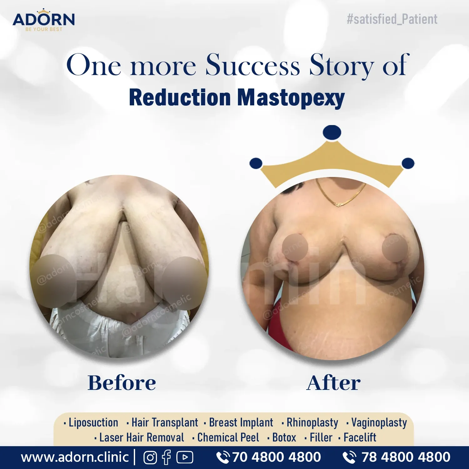 Breast Reduction | Before and After Plastic Surgery Results | Adorn Clinic