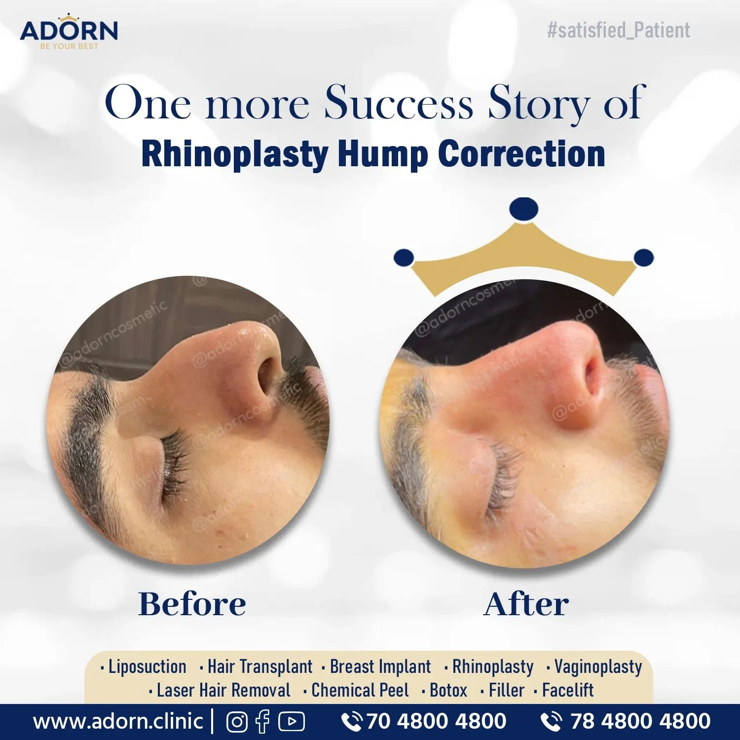 Nose Job