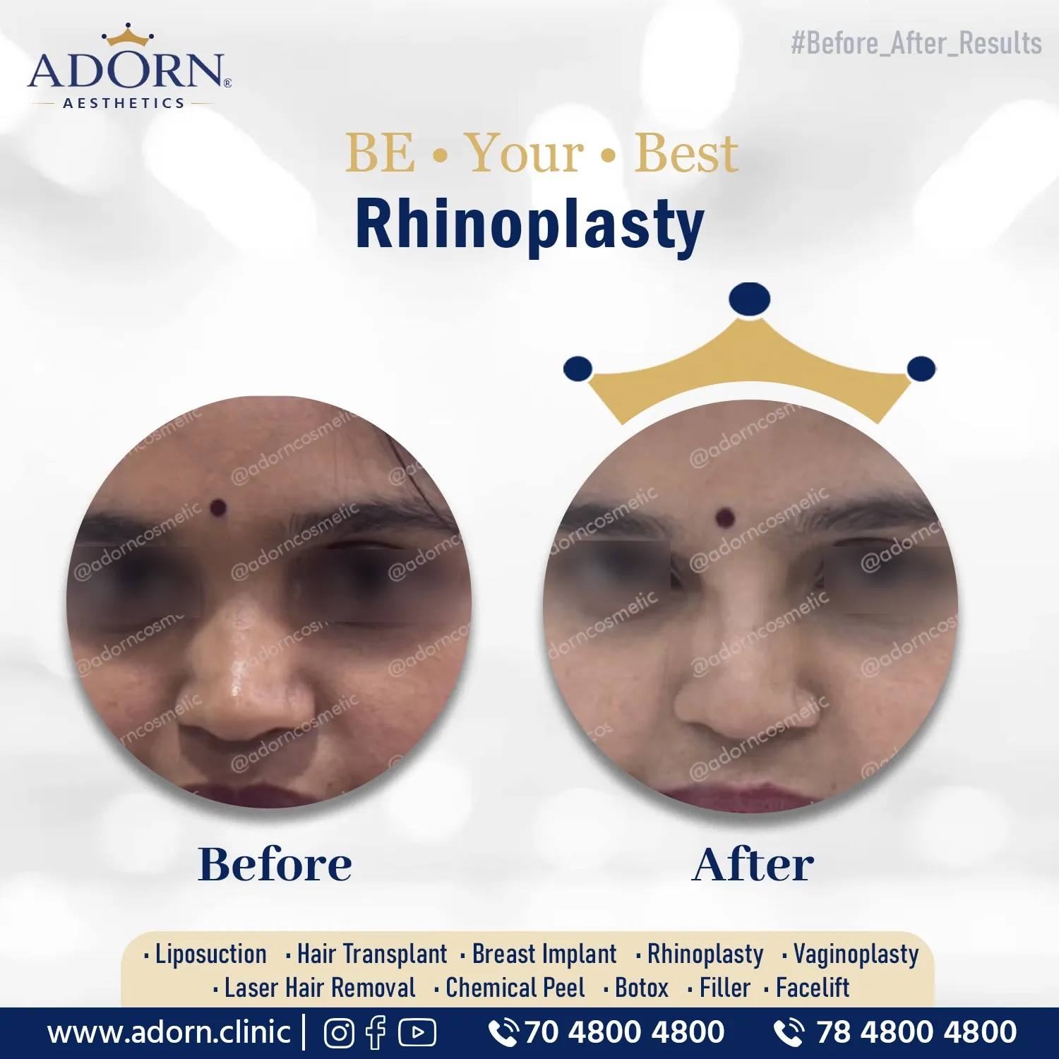 Nose Implant | Before and After Plastic Surgery Results | Adorn Clinic