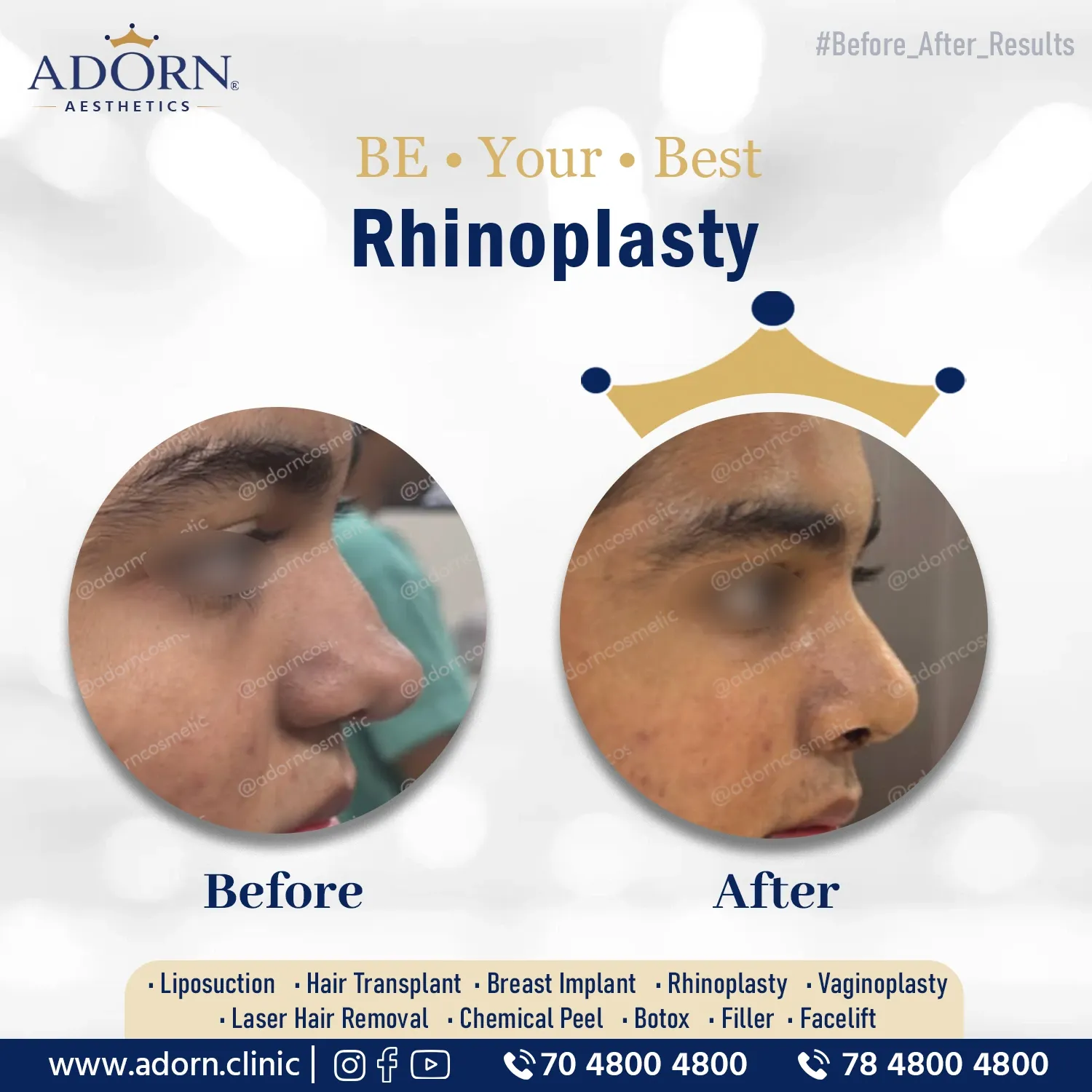 Rhinoplasty with Cartilage Graft | Before and After Plastic Surgery Results | Adorn Clinic
