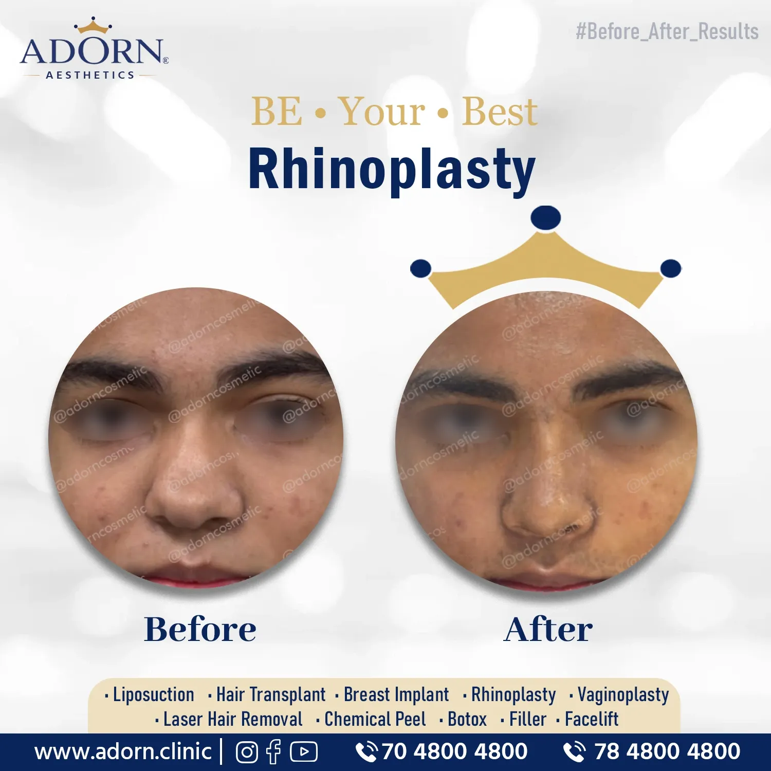 Cartilage Graft | Before and After Plastic Surgery Results | Adorn Clinic