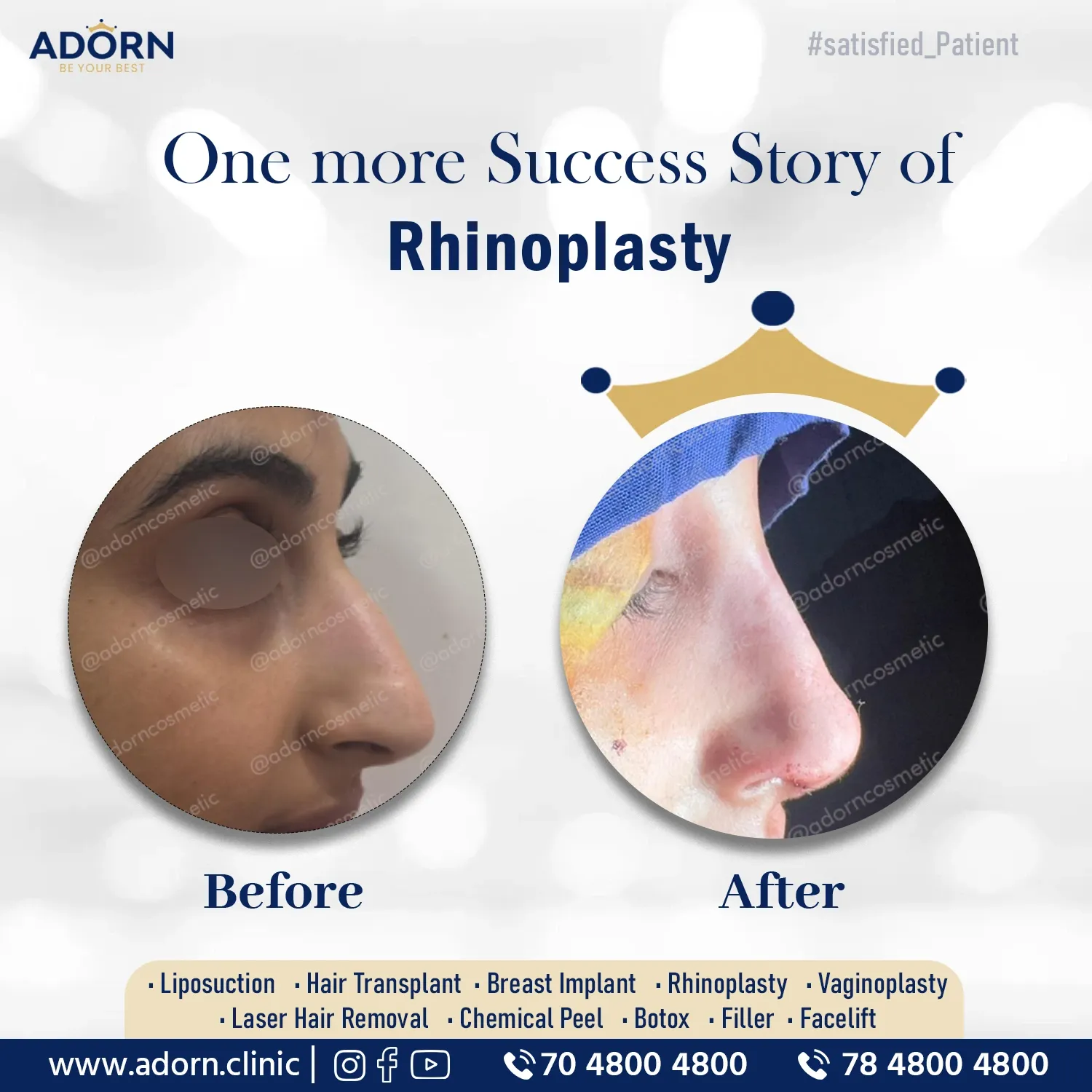 Long Nose Correction | Before and After Plastic Surgery Results | Adorn Clinic
