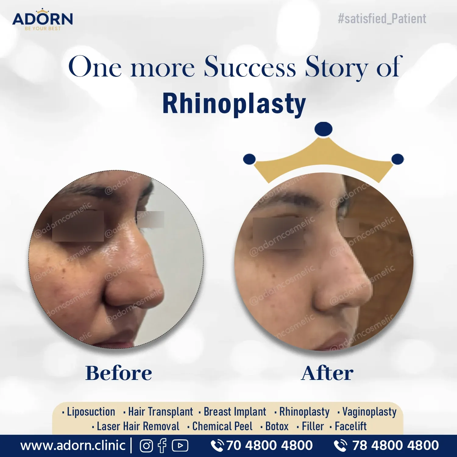 Female Rhinoplasty Hump | Before and After Plastic Surgery Results | Adorn Clinic