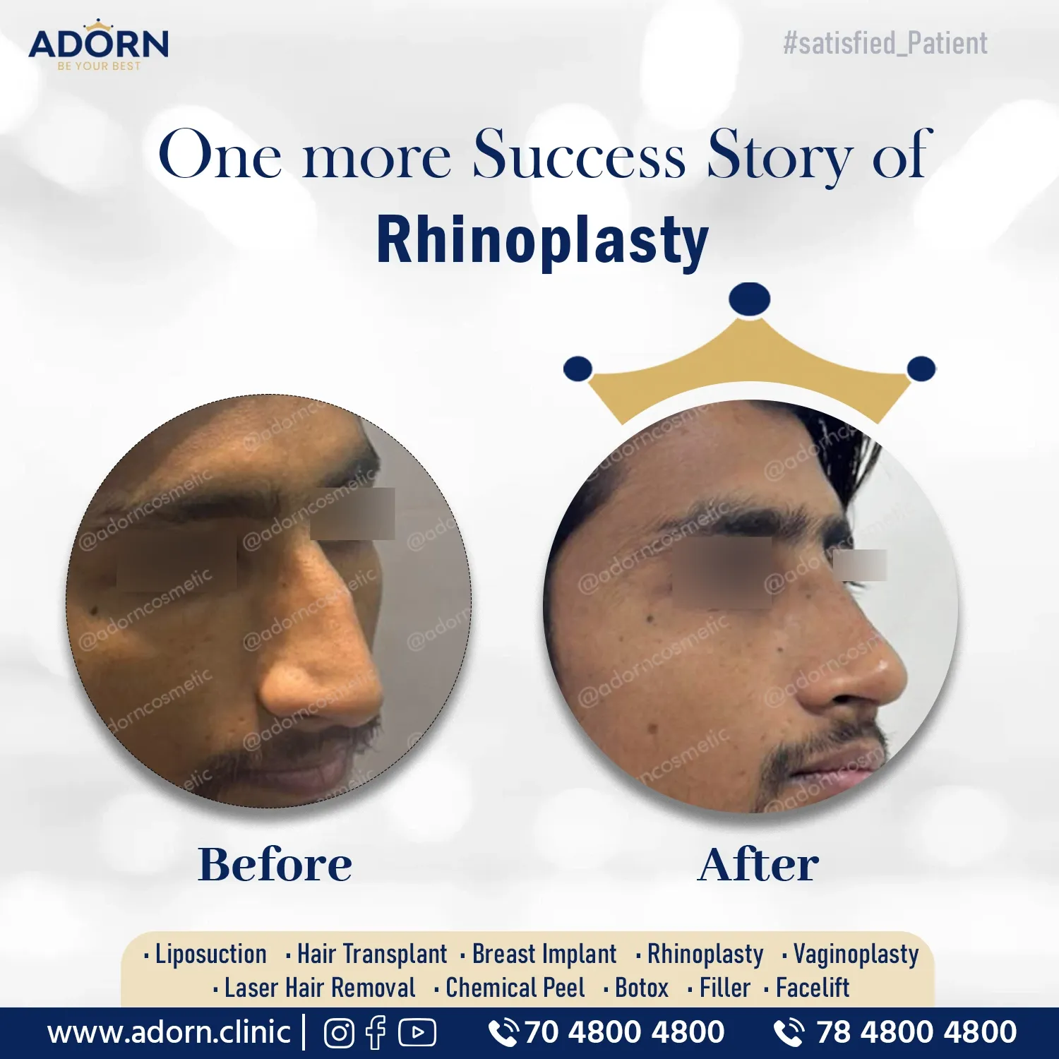 Hump Reduction Rhinoplasty | Before and After Plastic Surgery Results | Adorn Clinic