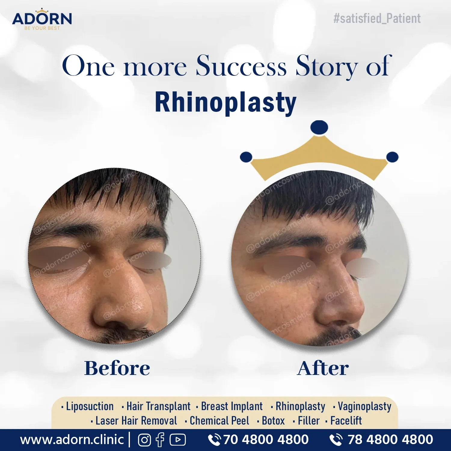 Hump Nose | Before and After Plastic Surgery Results | Adorn Clinic