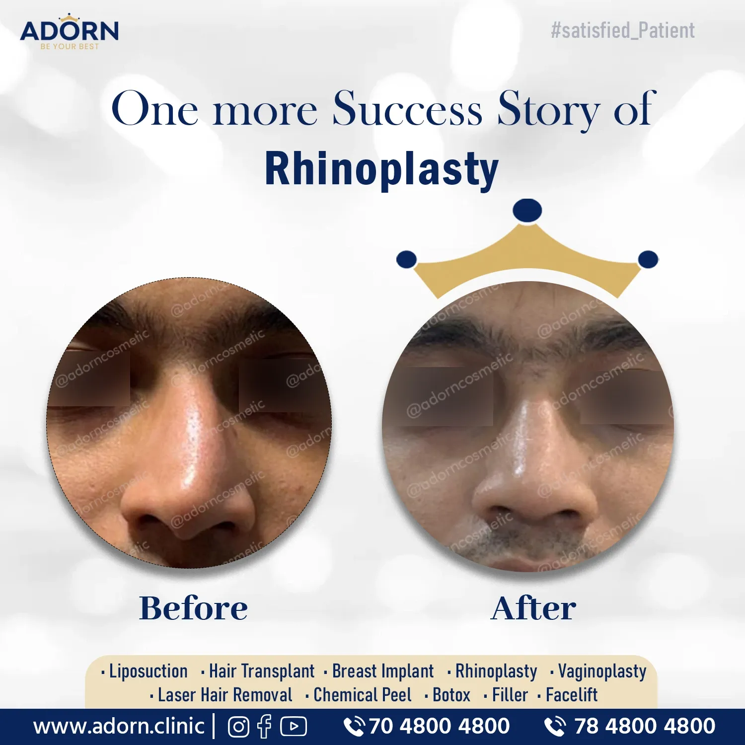 Crooked Nose Rhinoplasty | Before and After Plastic Surgery Results | Adorn Clinic