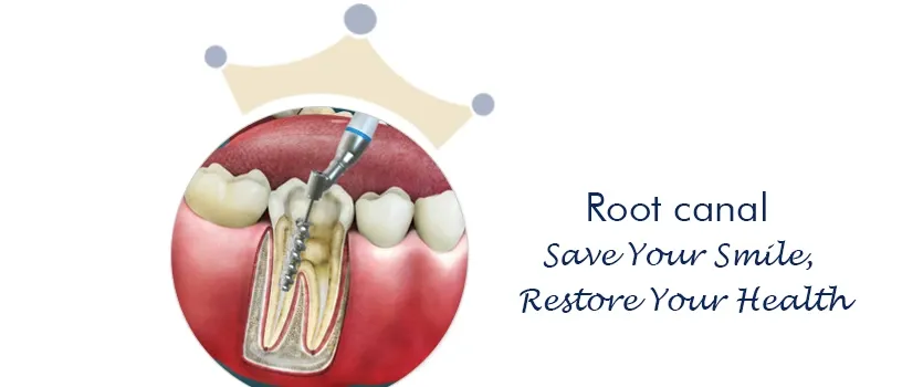 Root canal Treatment Ahmedabad