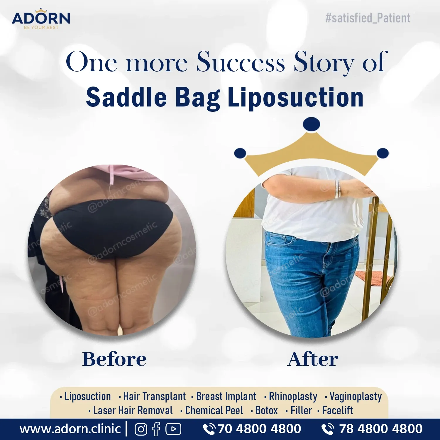 Saddle bag Lipo | Before and After Plastic Surgery Results | Adorn Clinic