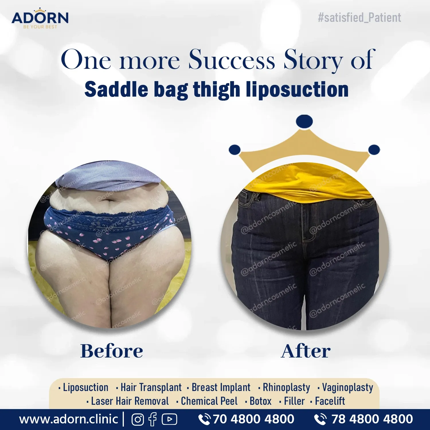 Saddle Bag Liposuction | Before and After Plastic Surgery Results | Adorn Clinic