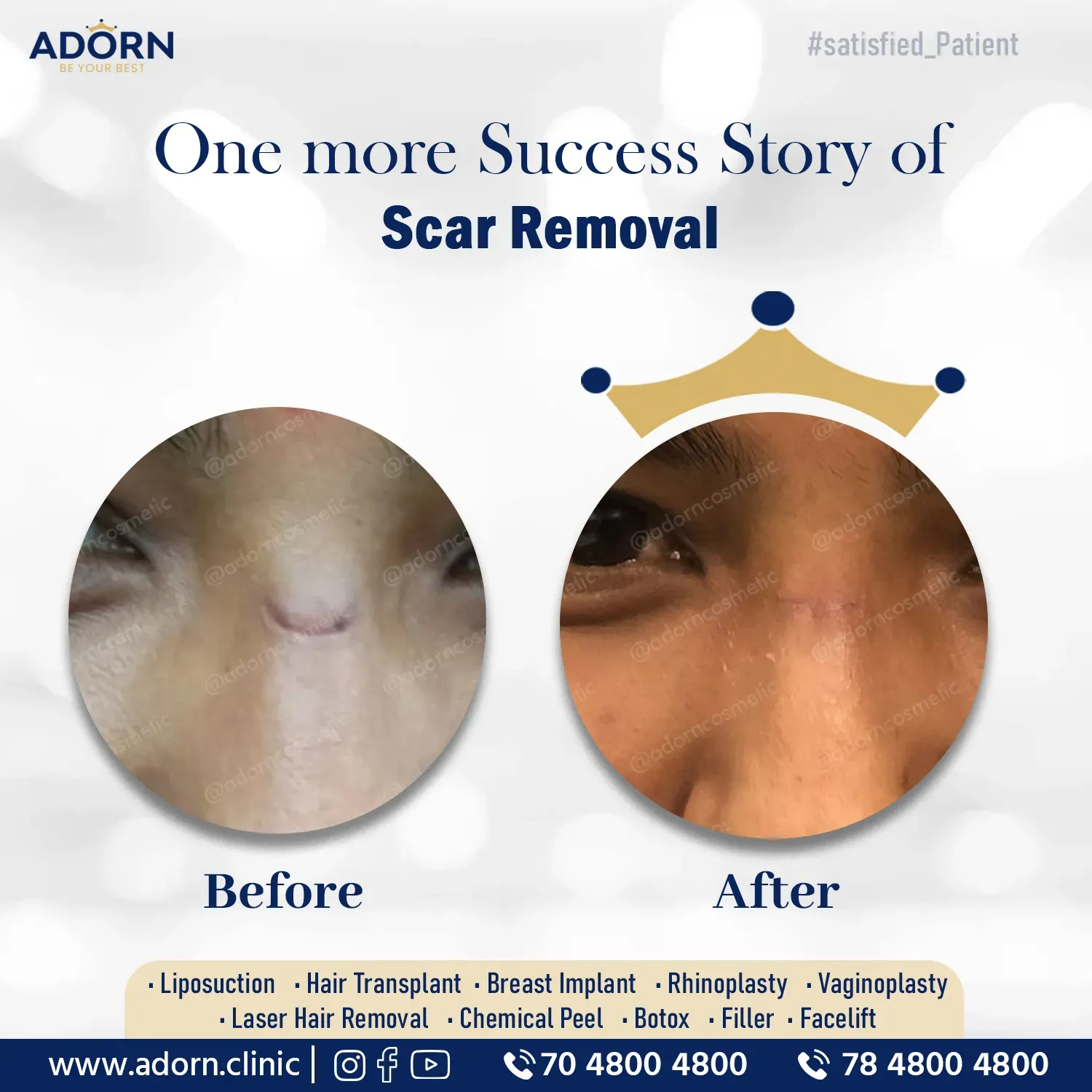 Wide scar | Before and After Plastic Surgery Results | Adorn Clinic