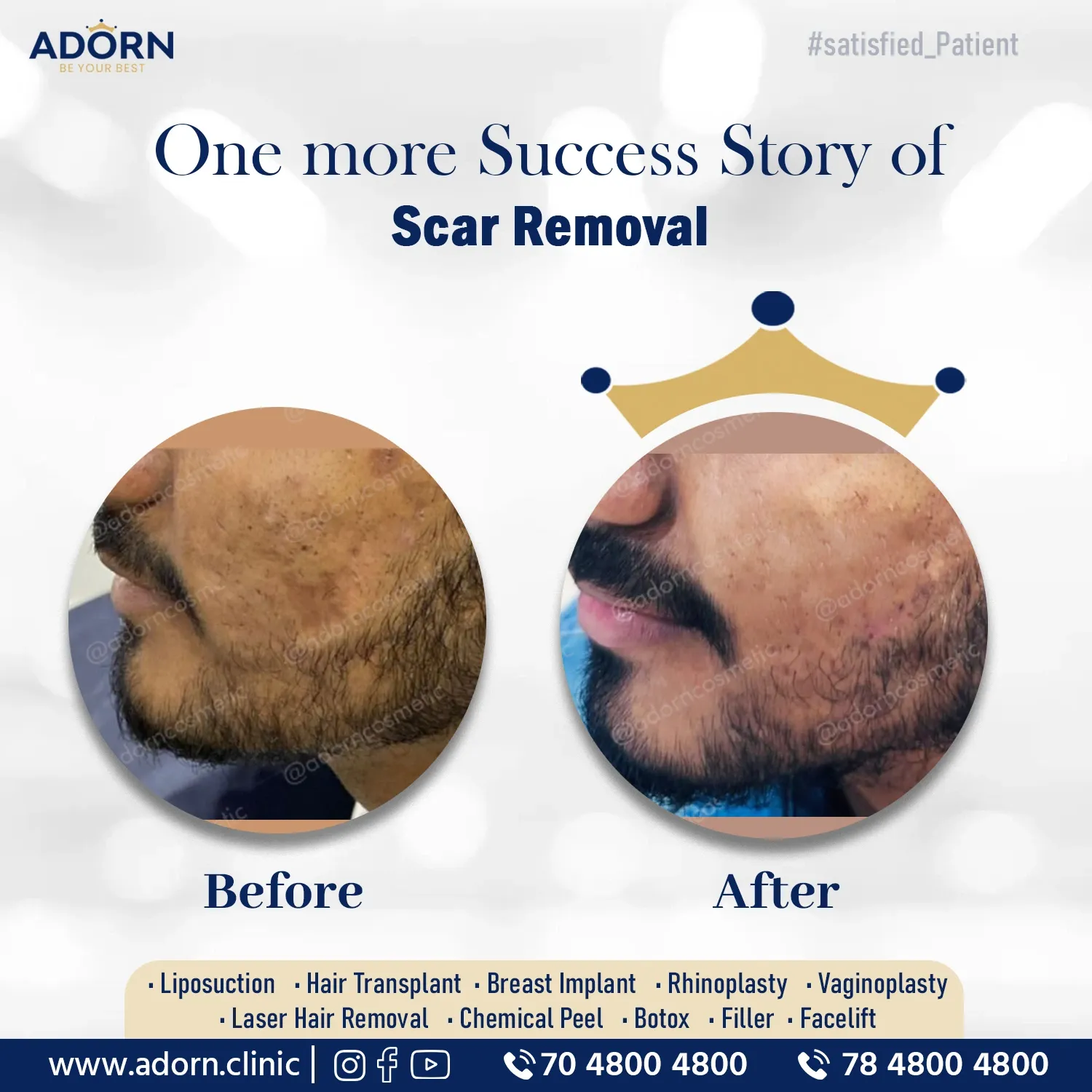 Acne Scar | Before and After Plastic Surgery Results | Adorn Clinic